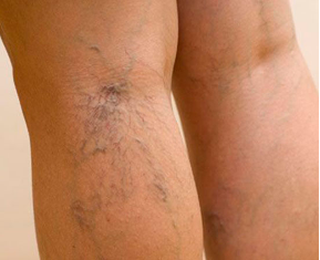 varices